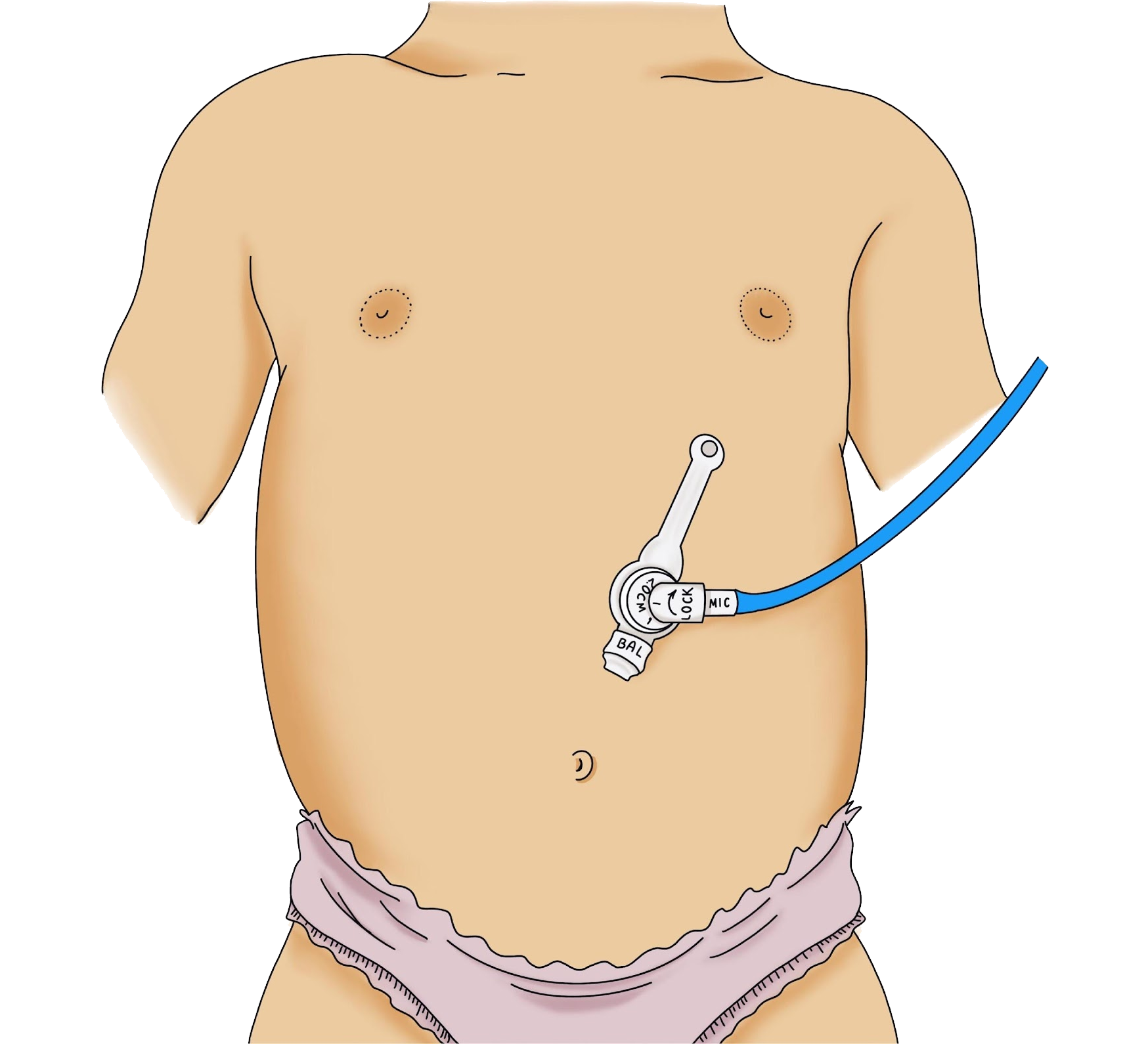 O que é uma Gastrostomia?